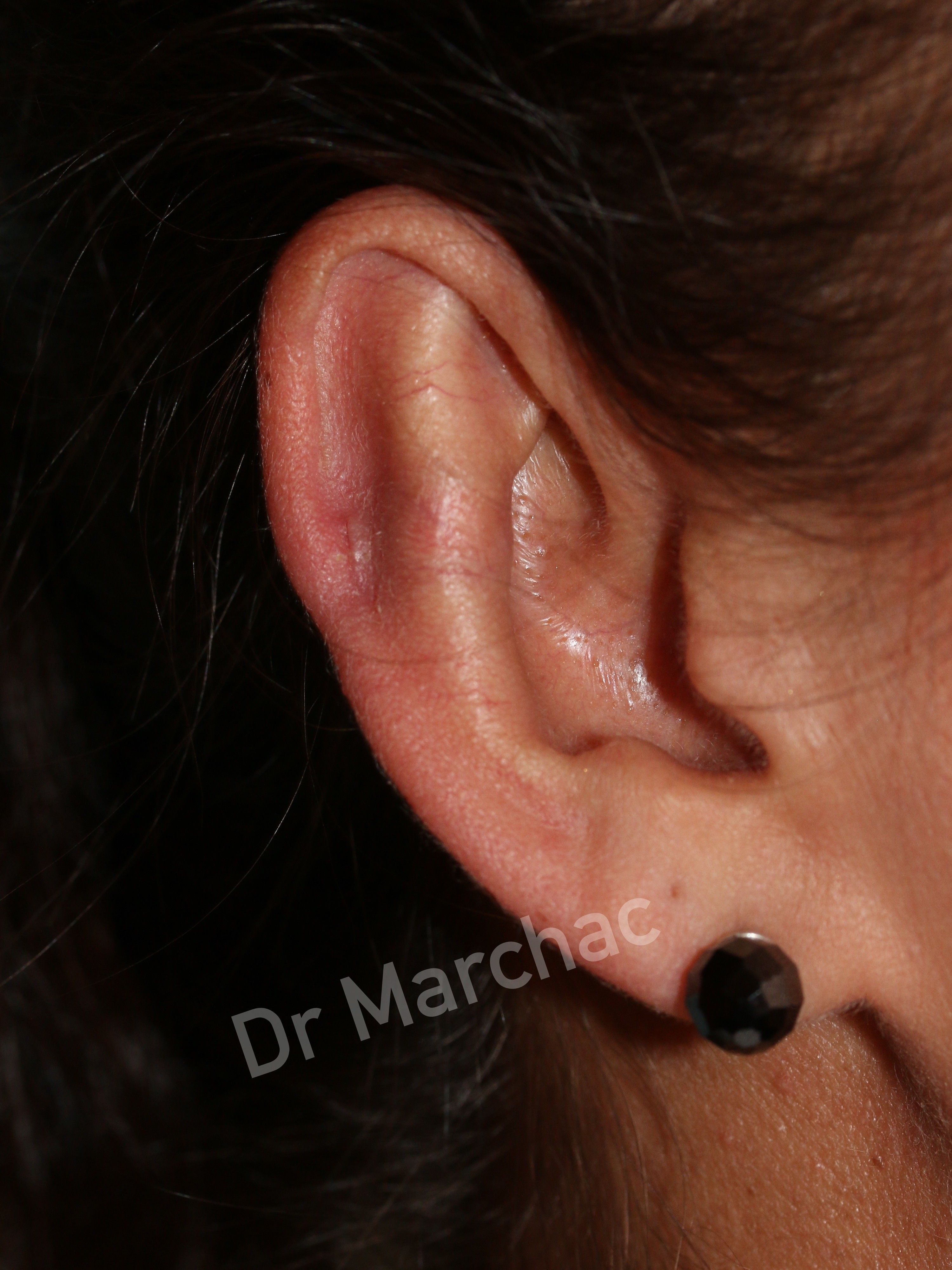 Photo après pose d'un implant Earfold pour corriger l'oreille décollée