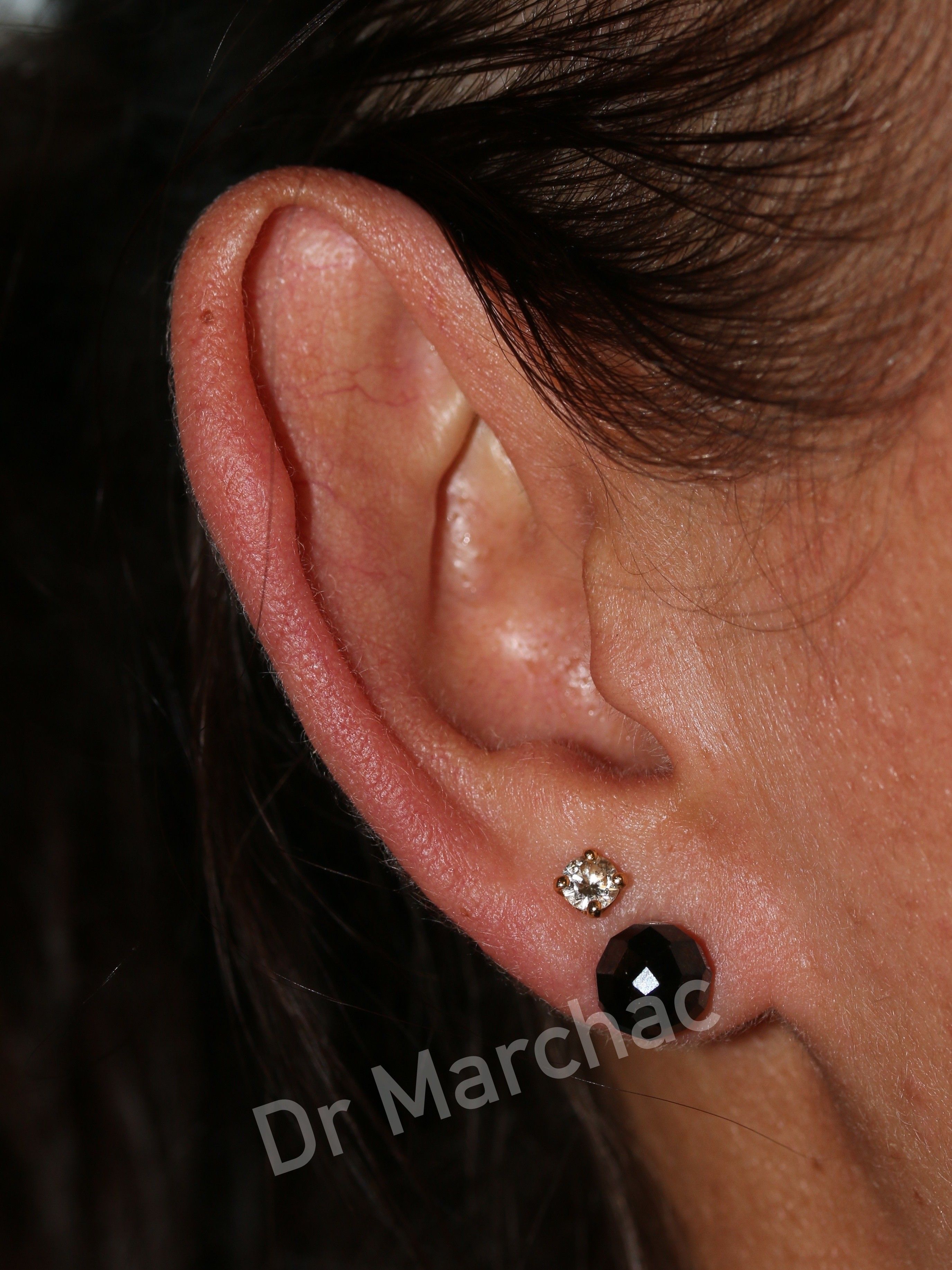 Photo avant pose d'un implant Earfold pour corriger l'oreille décollée 1