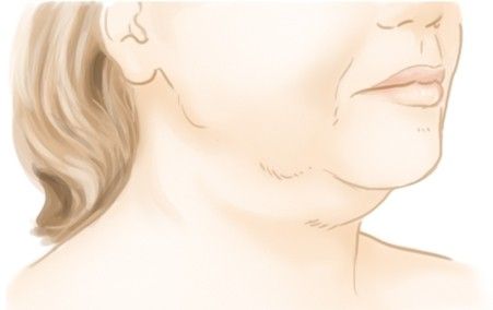 Les signes de vieillissement du cou : l'empâtement du cou