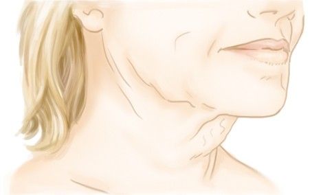 Les signes de vieillissement du cou : l'affaissement et la détente du cou