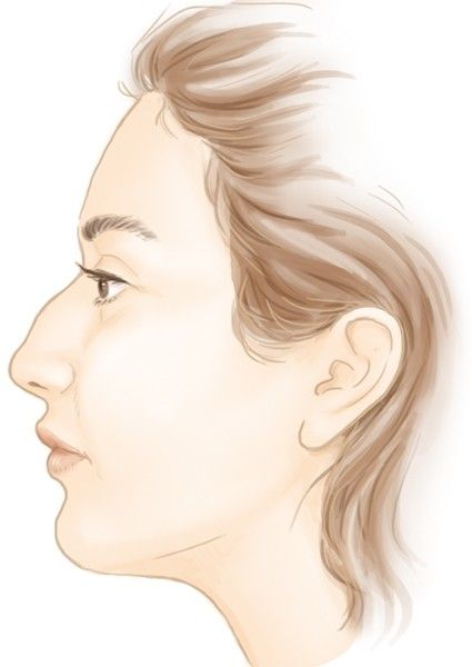 Le nez large, long et la bosse nasale par le Dr Marchac à Paris 16