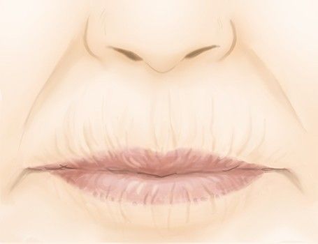 Les rides des lèvres par le Dr Marchac à Paris 16