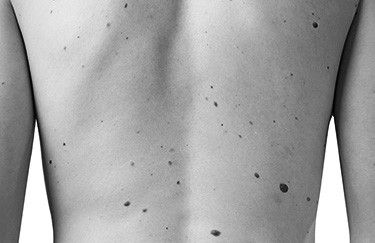 Traitement des cancers de la peau chez l'homme par le Dr Marchac Paris 16