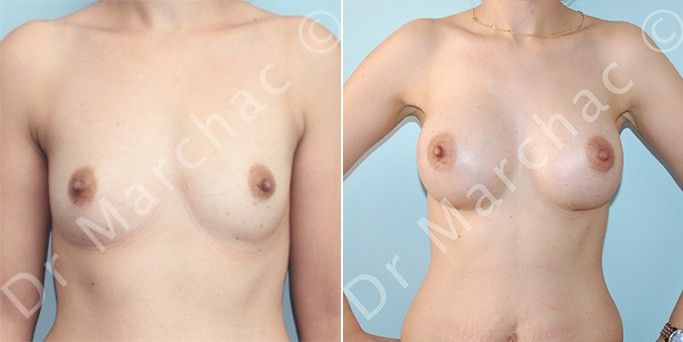 Augmentation mammaire : les photos avant/après du Dr Marchac