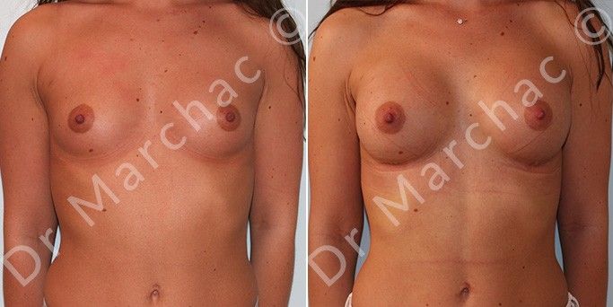 Photo avant/après augmentation mammaire pour l'hypotrophie mammaire