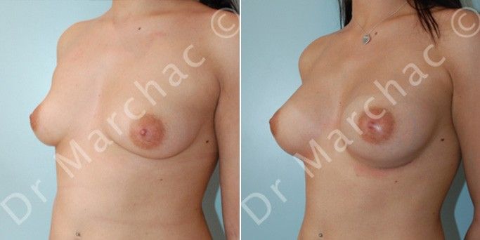 Avant/après augmentation du volume des seins par le Dr Marchac