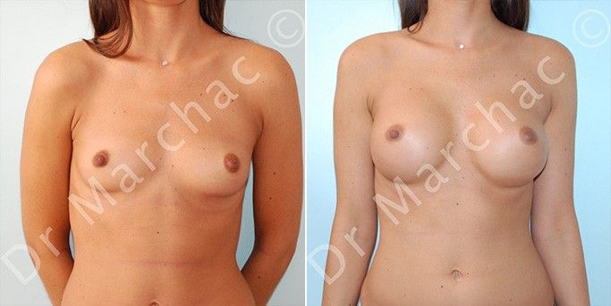 Avant/après chirurgie mammaire pour l'augmentation du volume des seins