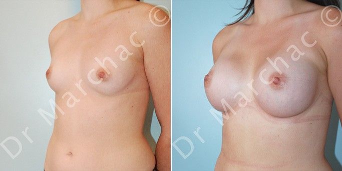 Avant/après l'augmentation mammaire par le Dr Marchac à Paris