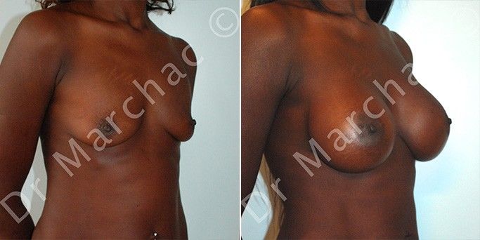 Photos avant/après la chirurgie esthétique de l'augmentation mammaire