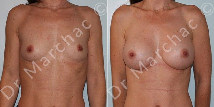 Photos avant/après l'augmentation mammaire par le Dr Marchac à Paris