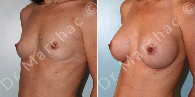 Avant/après chirurgie esthétique mammaire par le Dr Marchac