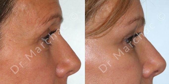 Blépharoplastie à Paris - Paupières lourdes - Dr Marchac 