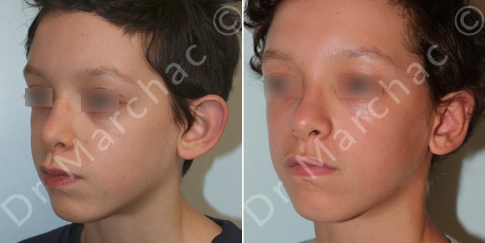 Chirurgie esthétique des oreilles décollées d'un adolescent - Dr Marchac Paris 16