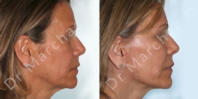 Photos avant et après d'un lifting du visage à Paris - Dr Marchac