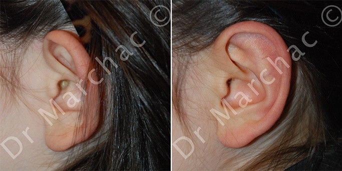 Photos avant/après otoplastie par points de suture par le Dr Marchac