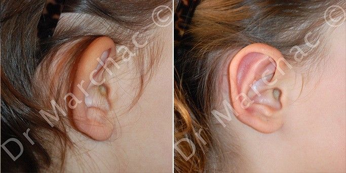 Photos avant/après chirurgie esthétique des oreilles décollées