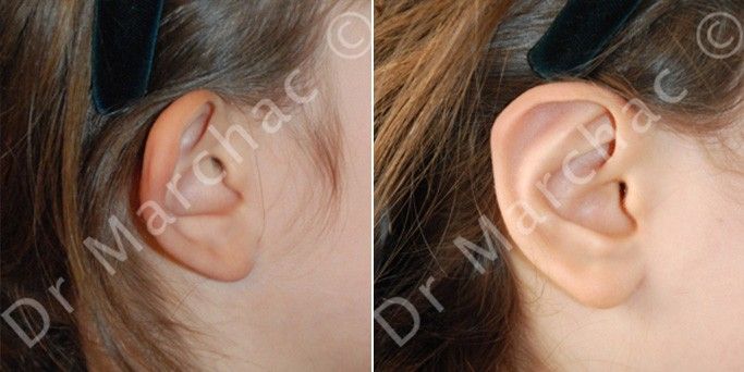 Avant/après correction des oreilles décollées par points de suture