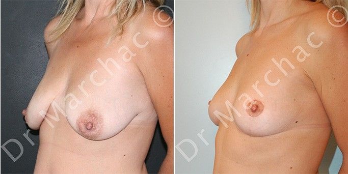 Avant/après mastopexie (lifting des seins) par le Dr Marchac