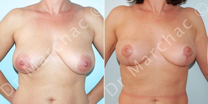 Photos avant/après correction de la ptose mammaire par mastopexie