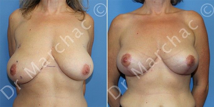 Photos avant/après lifting mammaire pour correction de la ptose