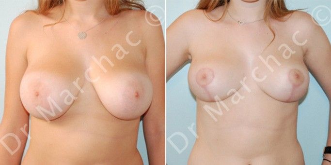Photos avant/après la réduction mammaire pour hypertrophie mammaire