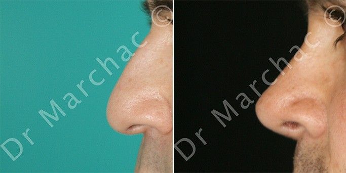 Avant/après la chirurgie esthétique du nez chez l'homme