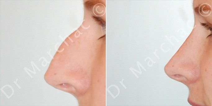 Photos avant/après rhinoplastie de la bosse du nez par le Dr Marchac