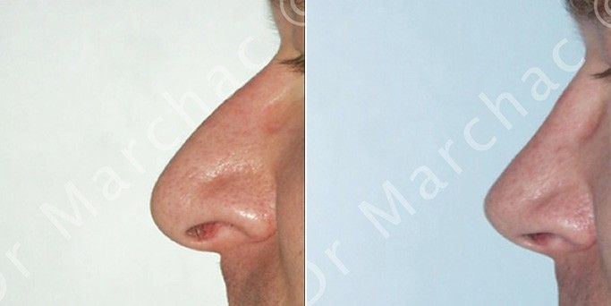 Photos avant/après la rhinoplastie chez l'homme par le Dr Marchac