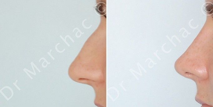 Photos avant/après diminution de la bosse du nez par le Dr Marchac