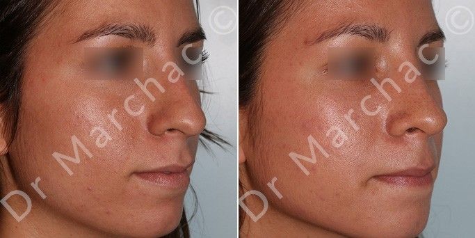 Photos avant/après chirurgie esthétique du nez par le Dr Marchac