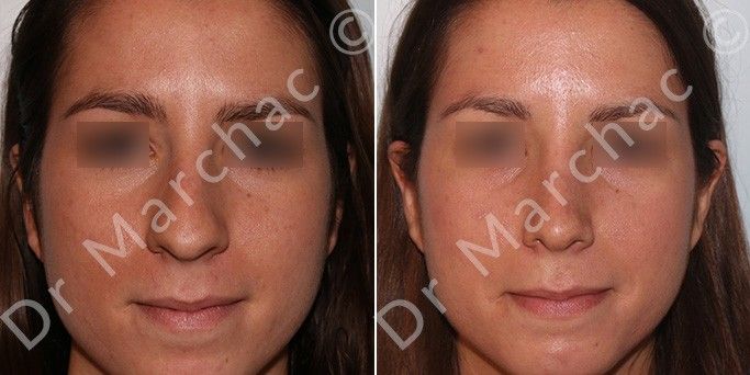 Photos avant/après de la chirurgie esthétique du nez chez la femme