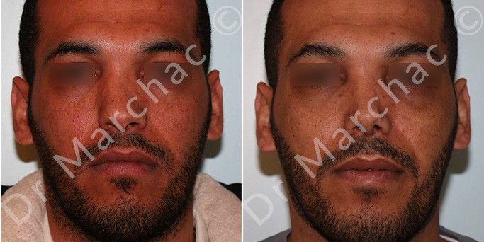 Le Dr Marchac réalise des rhinoplastie à Paris