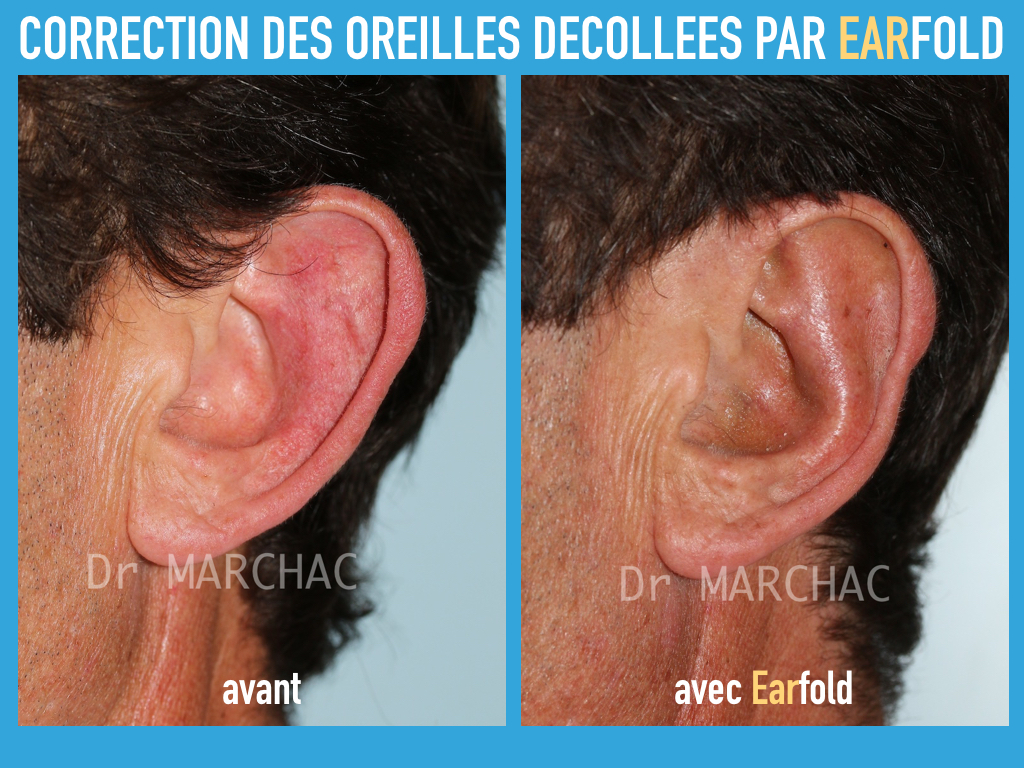 Avant/après correction des oreilles décollées par implant Earfold