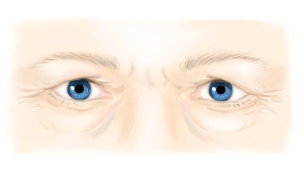Les signes de vieillissement des yeux
