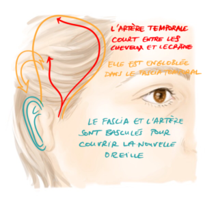 le fascia temporal et l'artère temporale superficielle sont utilisés pour reconstruire une microtie avec le Medpor