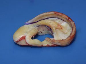 une oreille sculptée dans le cartilage costal aura exactement la forme de l'oreille normale